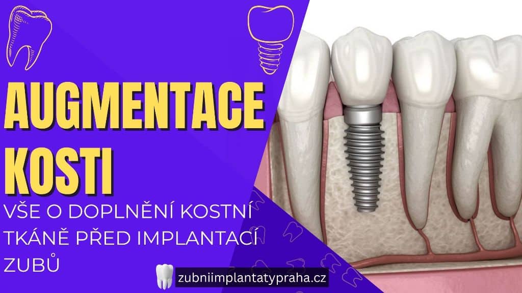 Augmentace kosti_ Vše o doplnění kostní tkáně před implantací zubů