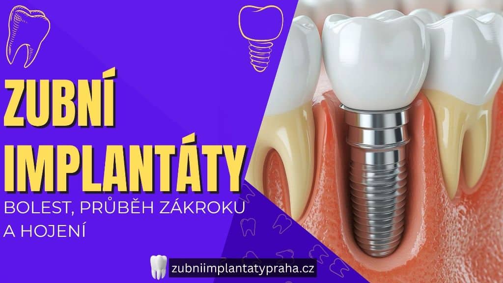 Zubní implantáty – bolest, průběh zákroku a hojení