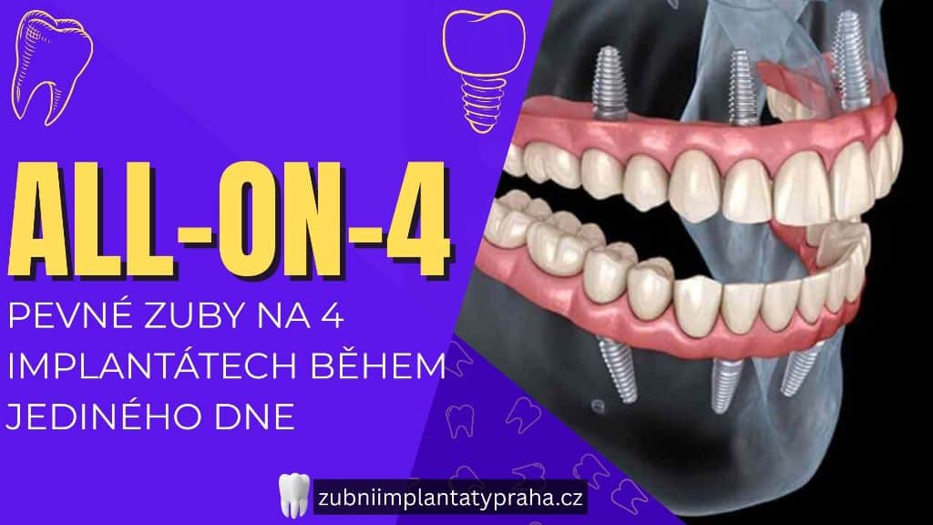 All-on-4_ Pevné zuby na 4 implantátech během jediného dne