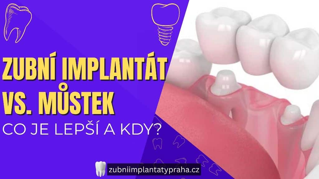 Zubní implantát vs. můstek_ Co je lepší a kdy