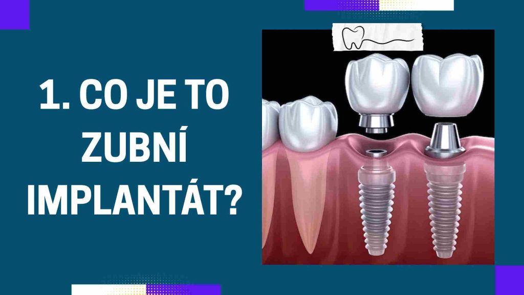 Co je to zubní implantát