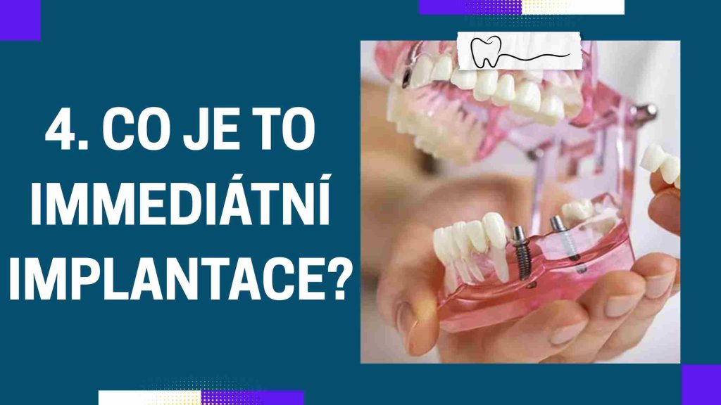Co je to immediátní implantace